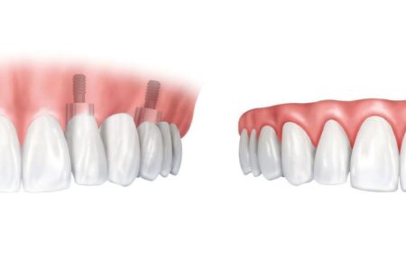 ایمپلنت دندان یا دندان مصنوعی ؟ کدام بهتر است ؟